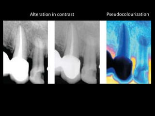 Alteration in contrast Pseudocolourization
 