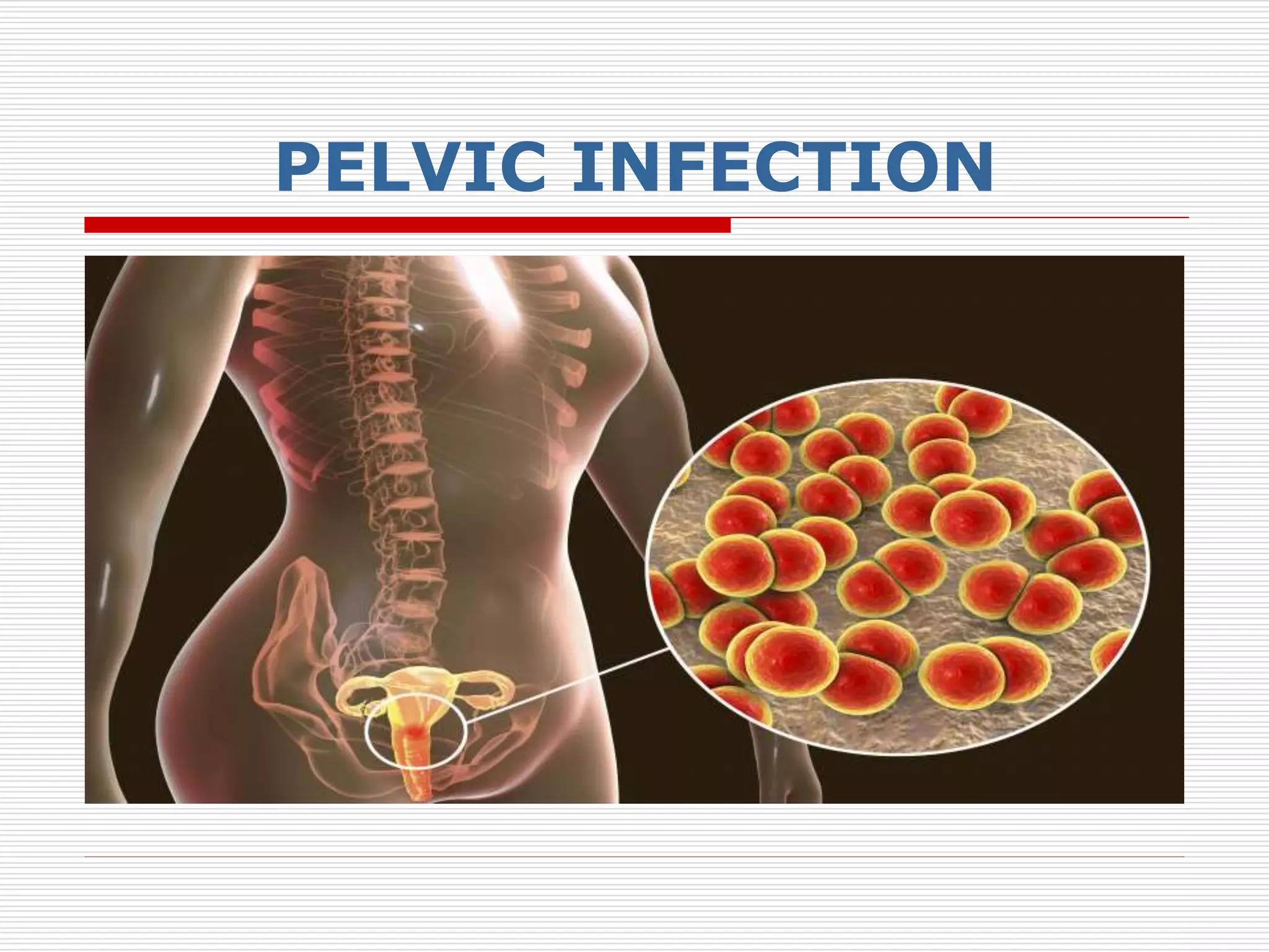 PELVIC INFECTION
 