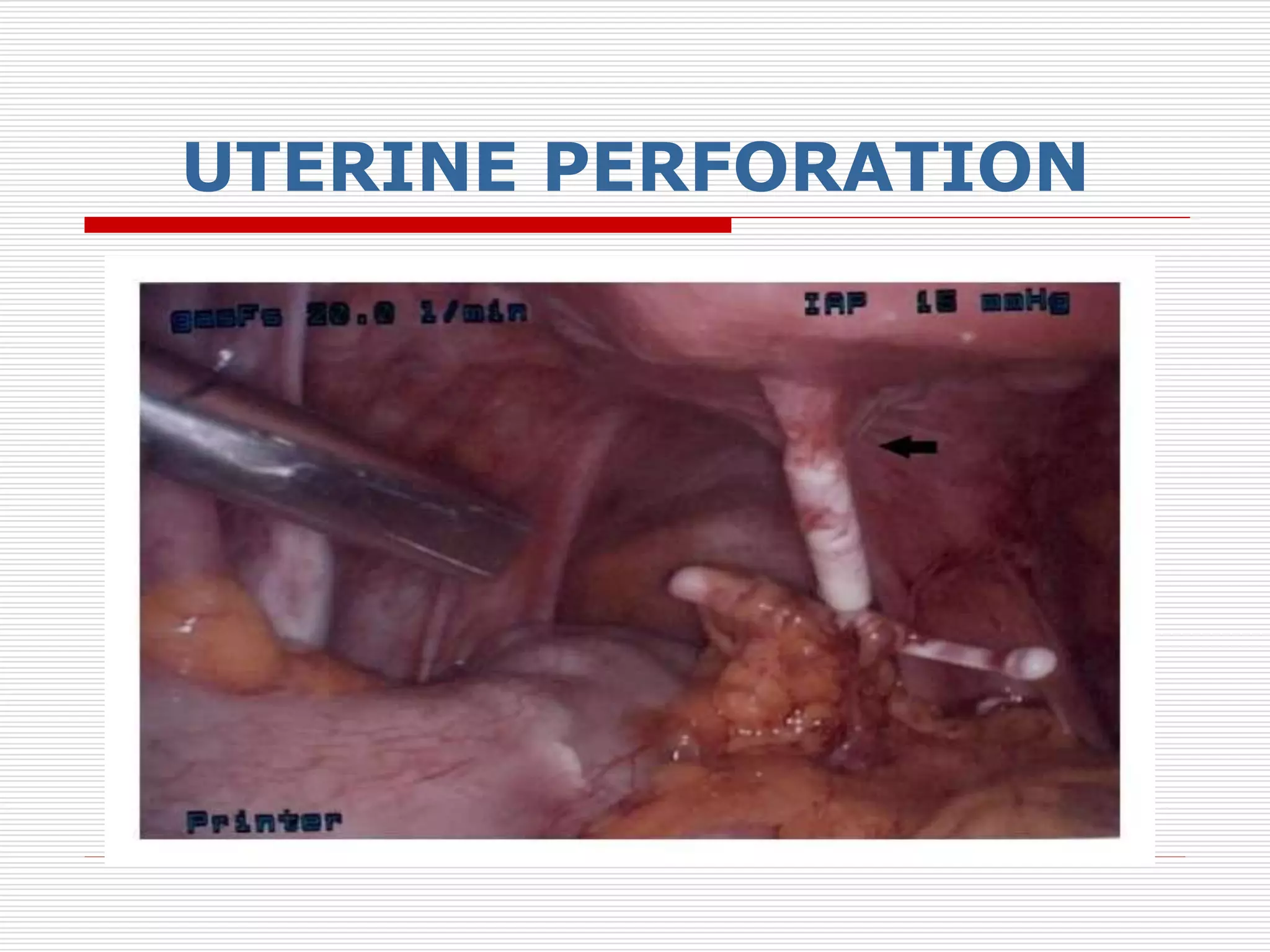 UTERINE PERFORATION
 