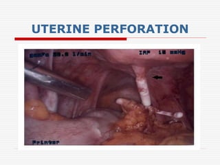 UTERINE PERFORATION
 