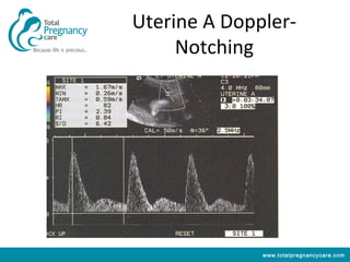Uterine A Doppler-
     Notching




              www.totalpregnancycare.com
 