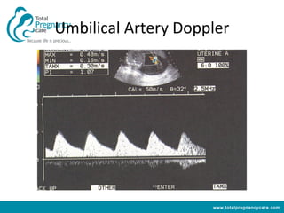 Umbilical Artery Doppler




                     www.totalpregnancycare.com
 