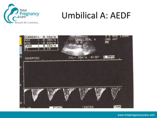 Umbilical A: AEDF




             www.totalpregnancycare.com
 