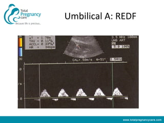 Umbilical A: REDF




             www.totalpregnancycare.com
 