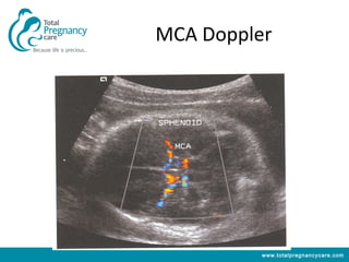 MCA Doppler




          www.totalpregnancycare.com
 