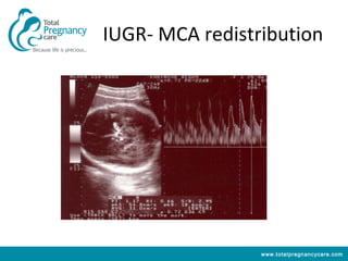IUGR- MCA redistribution




                 www.totalpregnancycare.com
 