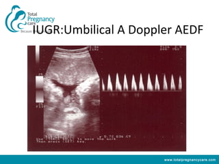 IUGR:Umbilical A Doppler AEDF




                      www.totalpregnancycare.com
 
