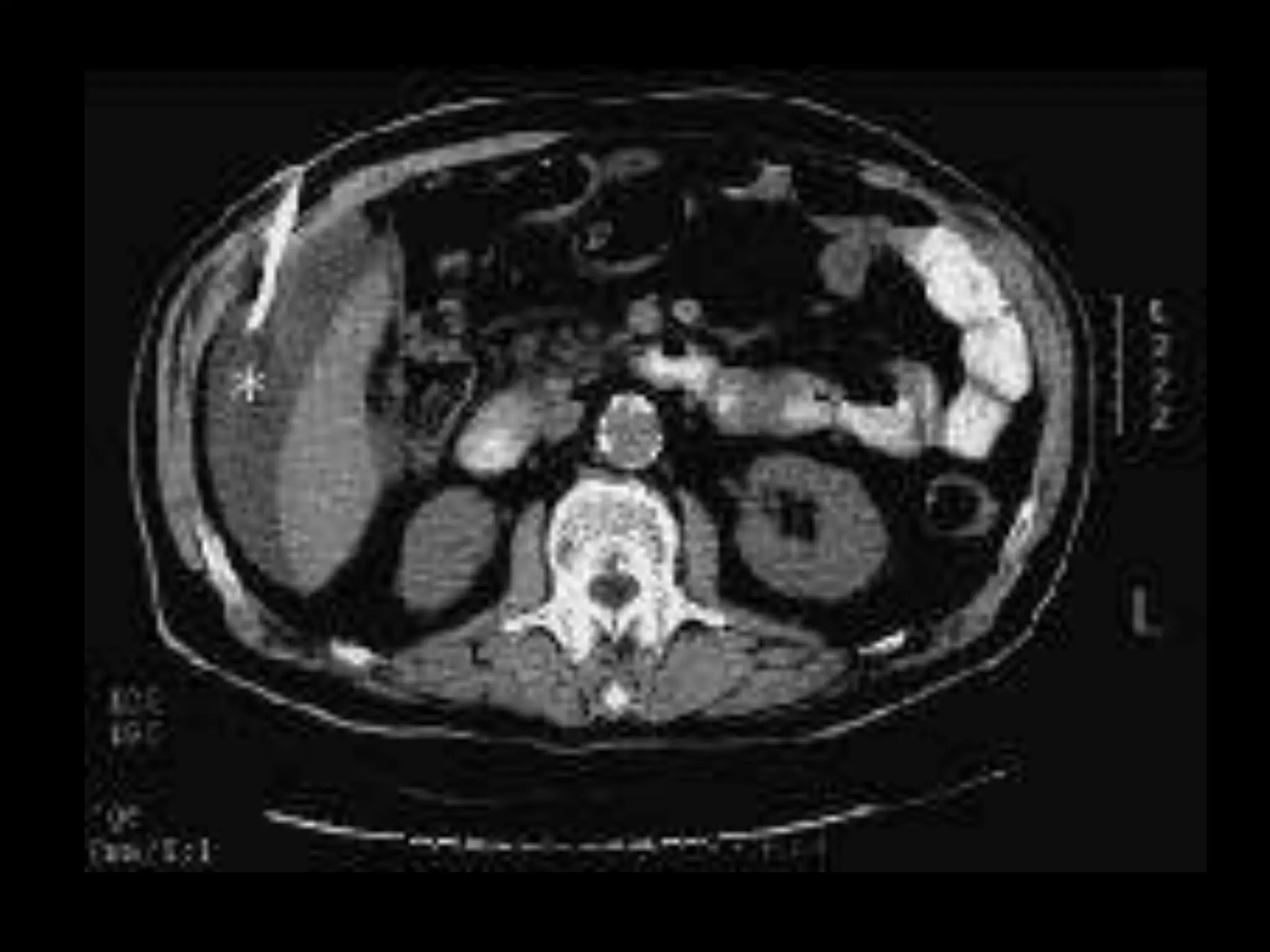 Intraabdominal abcess- types and management .pptx