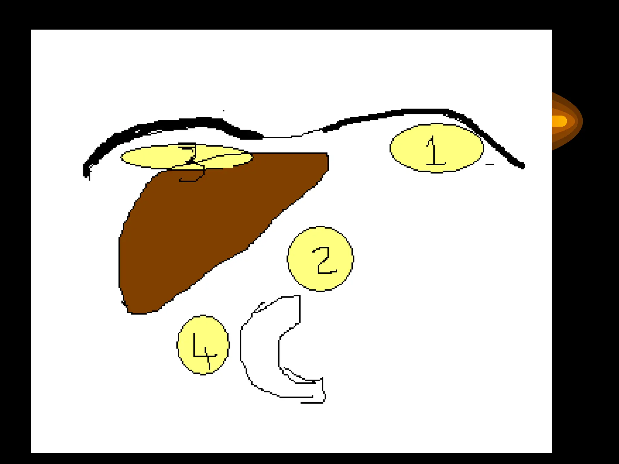 Intraabdominal abcess- types and management .pptx