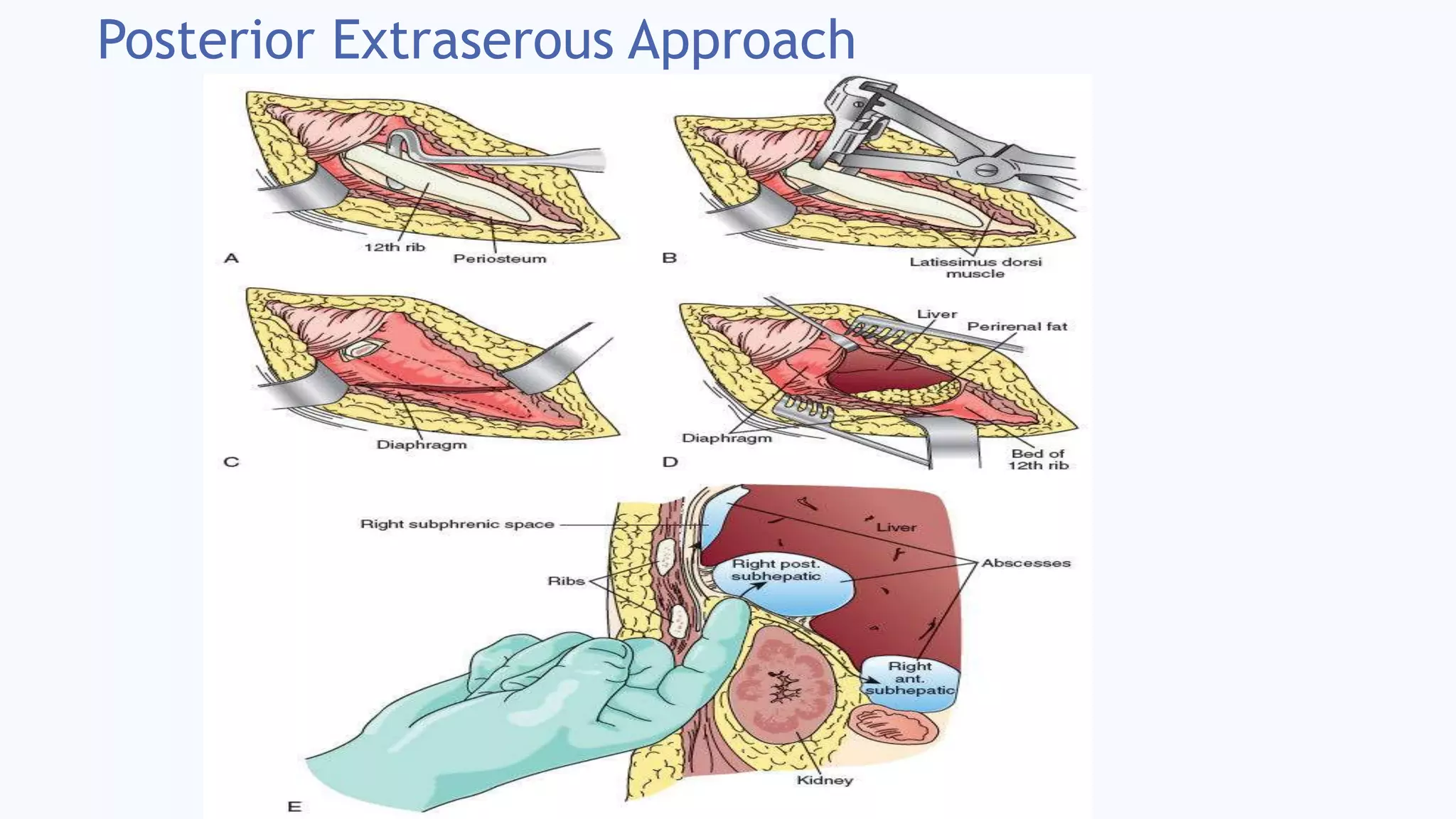 Posterior Extraserous Approach
 