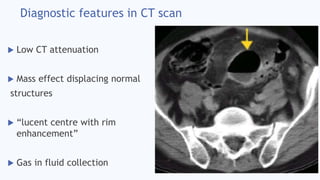 Diagnostic features in CT scan
 Low CT attenuation
 Mass effect displacing normal
structures
 “lucent centre with rim
enhancement”
 Gas in fluid collection
 