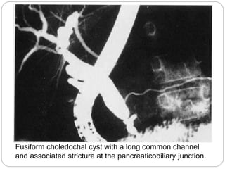 Fusiform choledochal cyst with a long common channel
and associated stricture at the pancreaticobiliary junction.
 