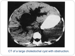 CT of a large choledochal cyst with obstruction.
 