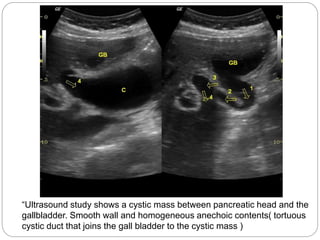 “Ultrasound study shows a cystic mass between pancreatic head and the
gallbladder. Smooth wall and homogeneous anechoic contents( tortuous
cystic duct that joins the gall bladder to the cystic mass )
 