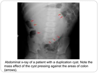 Abdominal x-ray of a patient with a duplication cyst. Note the
mass effect of the cyst pressing against the areas of colon
(arrows).
 