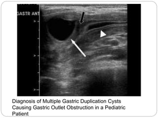 Diagnosis of Multiple Gastric Duplication Cysts
Causing Gastric Outlet Obstruction in a Pediatric
Patient
 