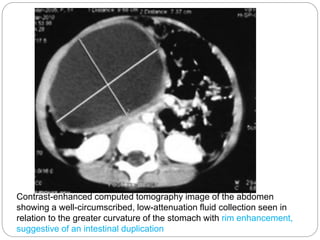 Contrast-enhanced computed tomography image of the abdomen
showing a well-circumscribed, low-attenuation fluid collection seen in
relation to the greater curvature of the stomach with rim enhancement,
suggestive of an intestinal duplication
 