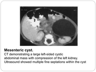 Mesenteric cyst.
CT demonstrating a large left-sided cystic
abdominal mass with compression of the left kidney.
Ultrasound showed multiple fine septations within the cyst
 