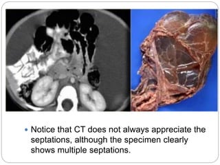  Notice that CT does not always appreciate the
septations, although the specimen clearly
shows multiple septations.
 