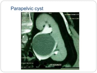 Parapelvic cyst
 
