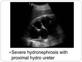 Severe hydronephrosis with
proximal hydro ureter
 