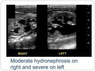 Moderate hydronephrosis on
right and severe on left
 