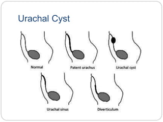 Urachal Cyst
 