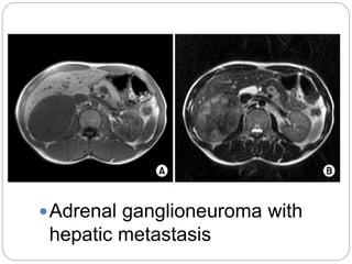 Adrenal ganglioneuroma with
hepatic metastasis
 