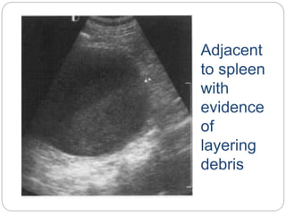 Adjacent
to spleen
with
evidence
of
layering
debris
 