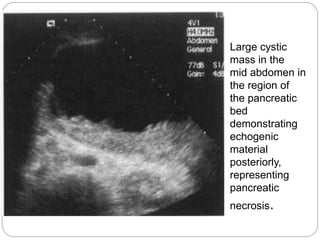 Large cystic
mass in the
mid abdomen in
the region of
the pancreatic
bed
demonstrating
echogenic
material
posteriorly,
representing
pancreatic
necrosis.
 