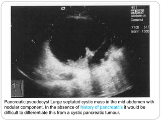 Pancreatic pseudocyst Large septated cystic mass in the mid abdomen with
nodular component. In the absence of history of pancreatitis it would be
difficult to differentiate this from a cystic pancreatic tumour.
 
