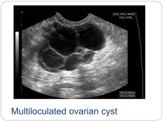Multiloculated ovarian cyst
 