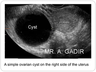 A simple ovarian cyst on the right side of the uterus
 
