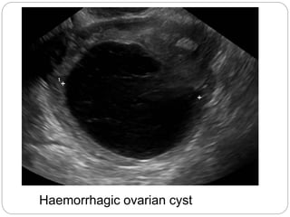 Haemorrhagic ovarian cyst
 