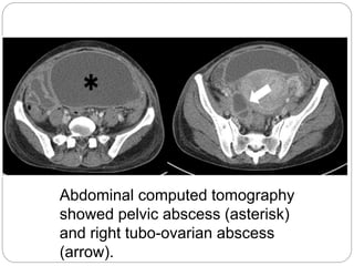 Abdominal computed tomography
showed pelvic abscess (asterisk)
and right tubo-ovarian abscess
(arrow).
 