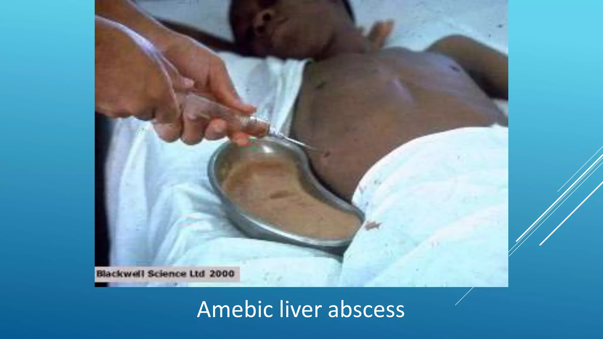 Intrabdominal abscess | PPTX