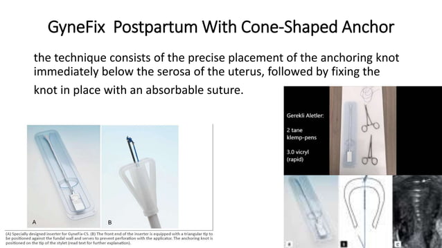 Intra caesarean loop (device or system ) insertion | PPTX