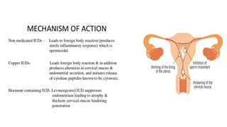Intra caesarean loop (device or system ) insertion | PPTX
