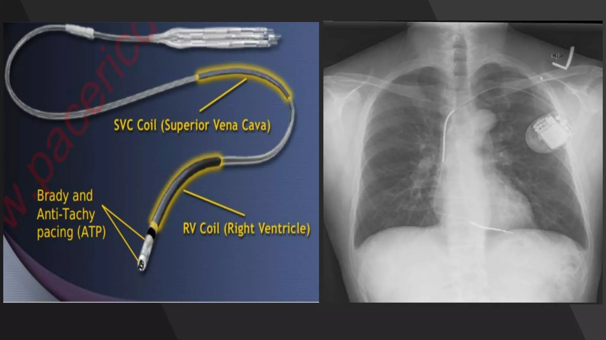 INTRACARDIAC DEVICES AND ITS COMPLICATION seminar..pptx