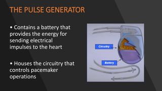 THE PULSE GENERATOR
• Contains a battery that
provides the energy for
sending electrical
impulses to the heart
• Houses the circuitry that
controls pacemaker
operations
 