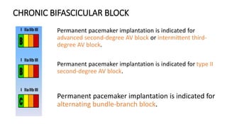 CHRONIC BIFASCICULAR BLOCK
Permanent pacemaker implantation is indicated for
advanced second-degree AV block or intermittent third-
degree AV block.
Permanent pacemaker implantation is indicated for type II
second-degree AV block.
Permanent pacemaker implantation is indicated for
alternating bundle-branch block.
 