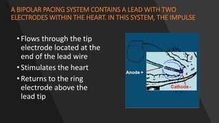 A BIPOLAR PACING SYSTEM CONTAINS A LEAD WITH TWO
ELECTRODES WITHIN THE HEART. IN THIS SYSTEM, THE IMPULSE
• Flows through the tip
electrode located at the
end of the lead wire
• Stimulates the heart
• Returns to the ring
electrode above the
lead tip
 