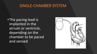 SINGLE-CHAMBER SYSTEM
•The pacing lead is
implanted in the
atrium or ventricle,
depending on the
chamber to be paced
and sensed
 