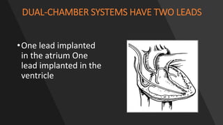 DUAL-CHAMBER SYSTEMS HAVE TWO LEADS
•One lead implanted
in the atrium One
lead implanted in the
ventricle
 