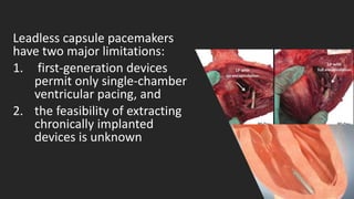 Leadless capsule pacemakers
have two major limitations:
1. first-generation devices
permit only single-chamber
ventricular pacing, and
2. the feasibility of extracting
chronically implanted
devices is unknown
 