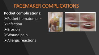 PACEMAKER COMPLICATIONS
Pocket complications:
Pocket hematoma
Infection
Erosion
Wound pain
Allergic reactions
 