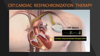 CRT:CARDIAC RESYNCHRONIZATION THERAPY
 
