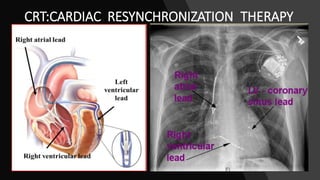CRT:CARDIAC RESYNCHRONIZATION THERAPY
 