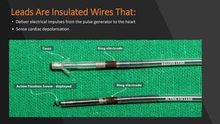 Leads Are Insulated Wires That:
• Deliver electrical impulses from the pulse generator to the heart
• Sense cardiac depolarisation
 