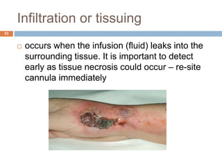 Infiltration or tissuing
33
 occurs when the infusion (fluid) leaks into the
surrounding tissue. It is important to detect
early as tissue necrosis could occur – re-site
cannula immediately
 